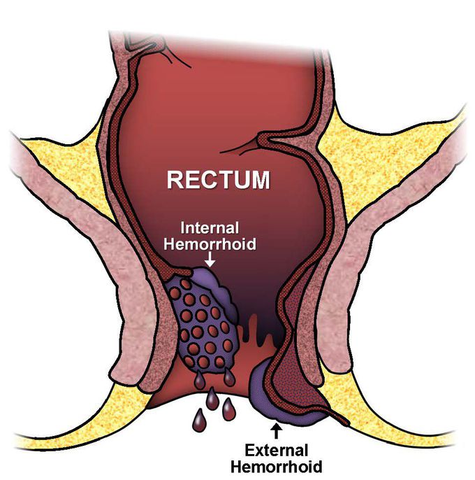 How do healthcare providers treat hemorrhoids?