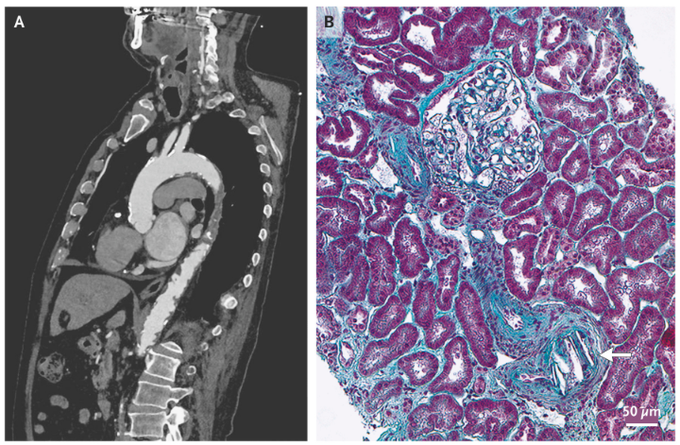 Cholesterol Crystal Embolization after Transcatheter Aortic-Valve Replacement