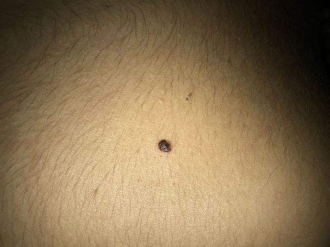 What is this? What kind of mole is this?