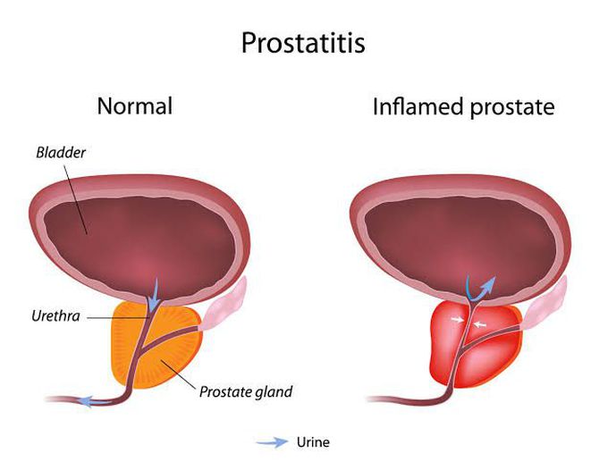 Acute Bacterial Prostatitis