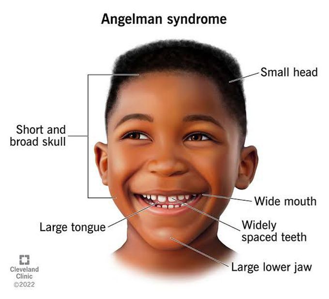 Angelman syndrome