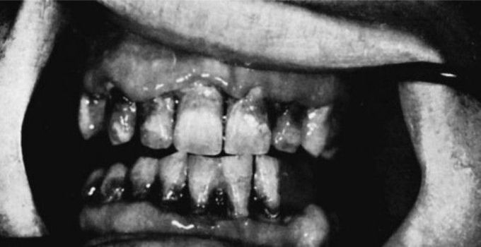 Acute necrotizing ulcerative gingivitis