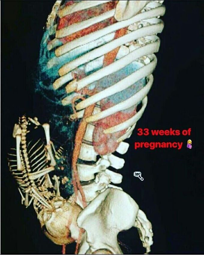 33 wks of pregnancy