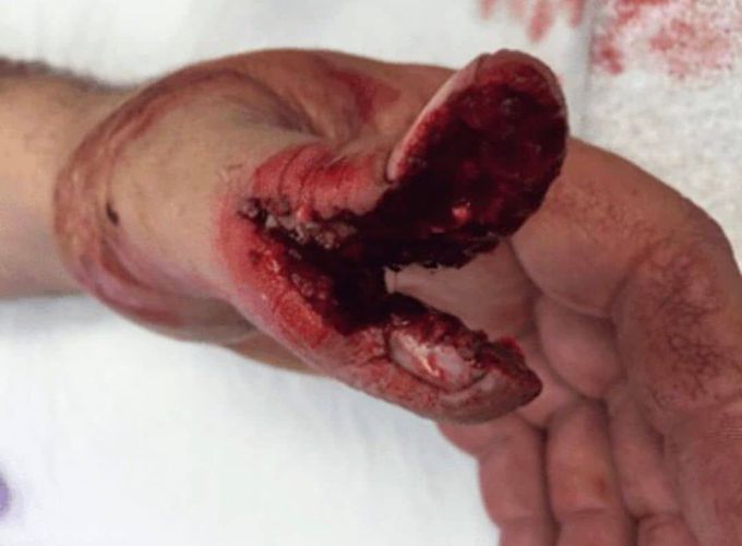 Table saw accident splitting the thumb in half! ⚠️