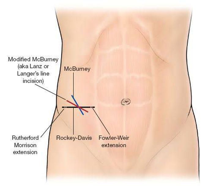 McBurney Incision