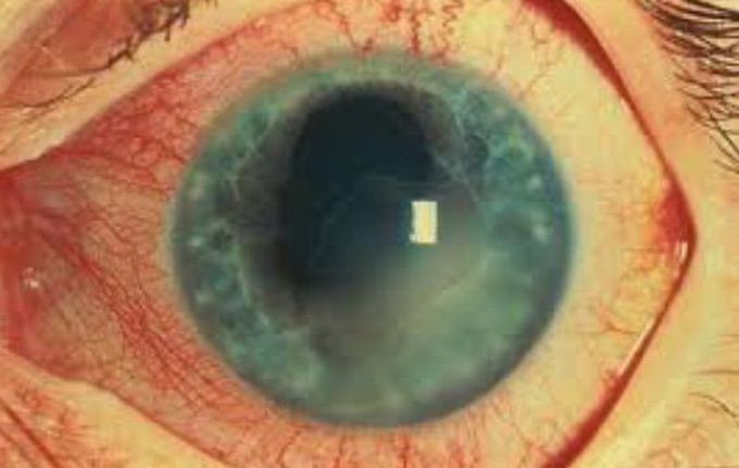 Eye cases