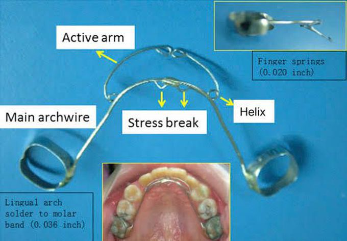 Parts Of The Ortho Retainer