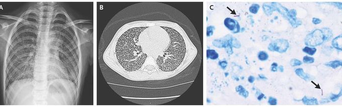 Drug-Resistant Miliary Tuberculosis in a Child