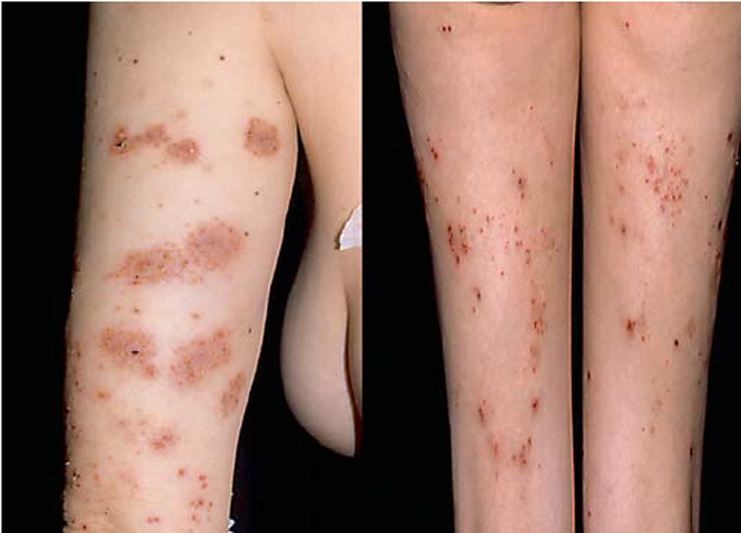 Typical lesions of DH in a celiac patient.