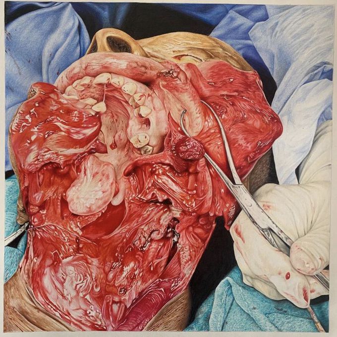 Coloured pencil illustration of a mandibulectomy and neck dissection