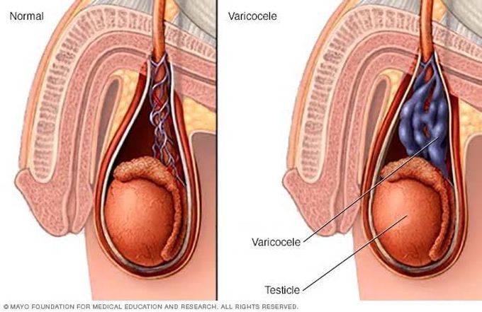 Causes of varicocele