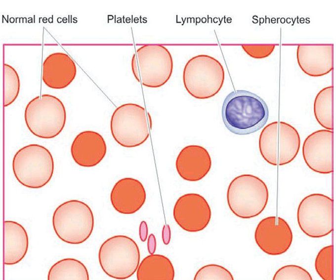 Hereditary spherocytosis.