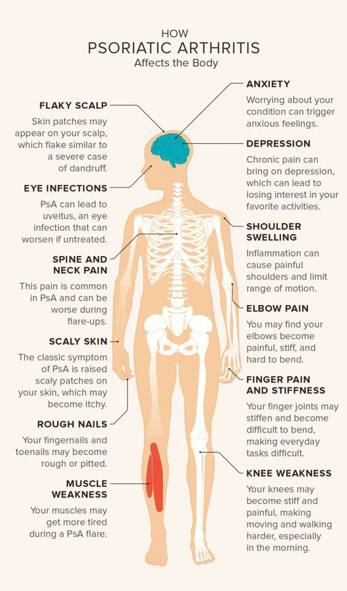 Psoriatic arthritis