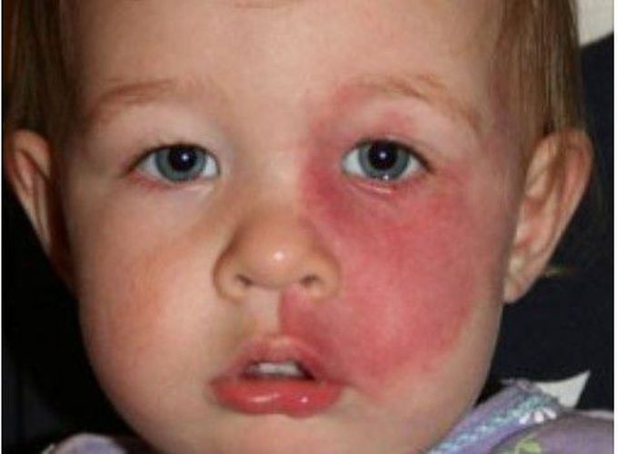 Sturge Weber Syndrome