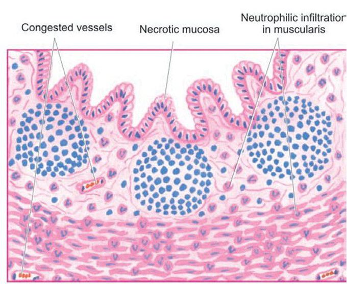 Acute appendicitis