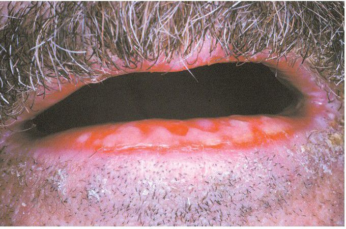 Chemotherapy-related Epithelial Necrosis.