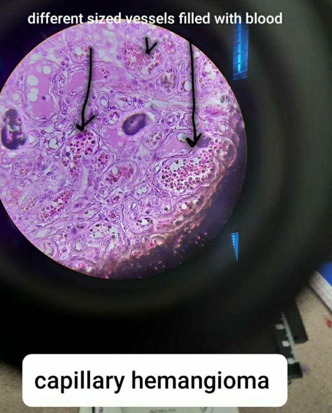 Microscopically view of capilary hemangioma