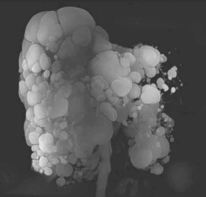 Liver Involvement in Autosomal Dominant Polycystic Kidney Disease