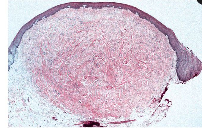 Fibroma histopathology