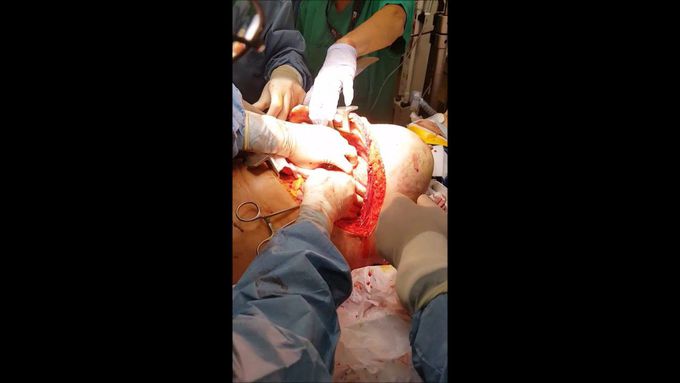 ED Resuscitative Thoracotomy in blunt thoracic trauma