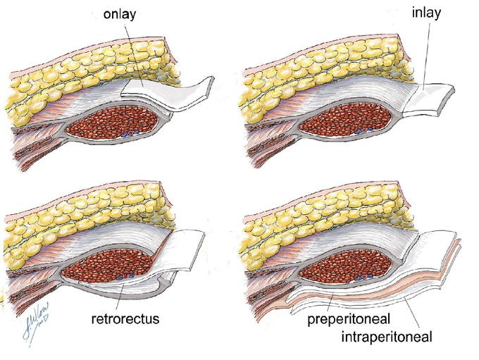 Onlay vs Inlay vs Sublay Mesh Repair For Hernia