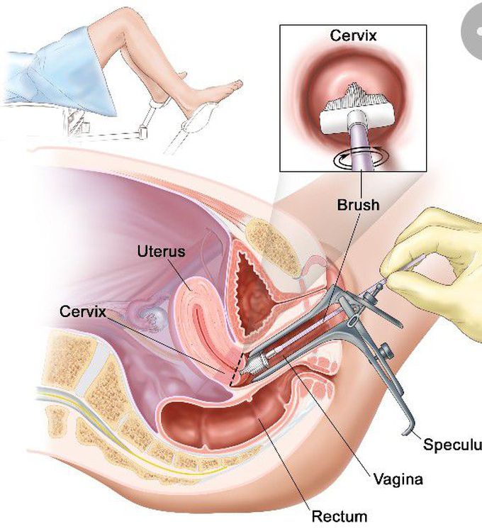 Pap smear