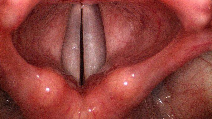 Vocal cords