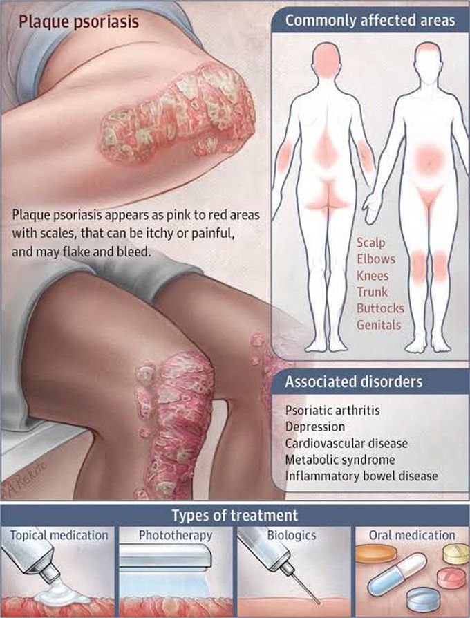 Plaque Psoriasis