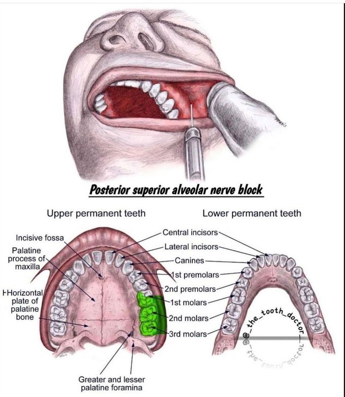 Posterior Superior Alveolar Nerve