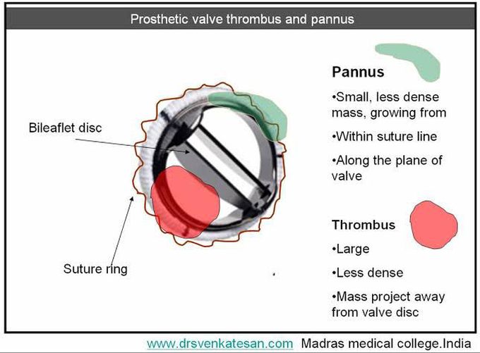 Thrombus Vs Pannus