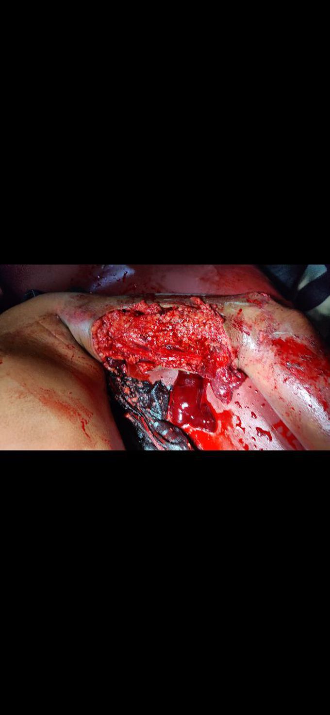 Traumatic laceration of left arm