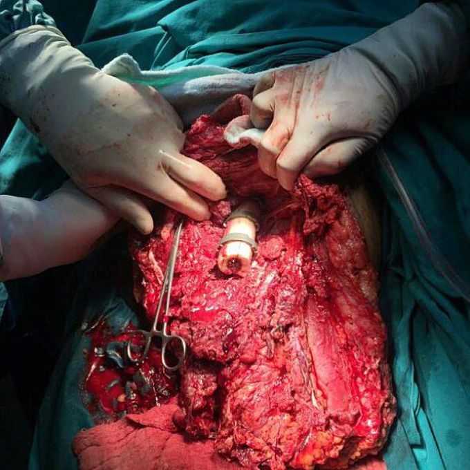 Severe femoral traumatic injury and above-knee amputation as a result of a road traffic accident