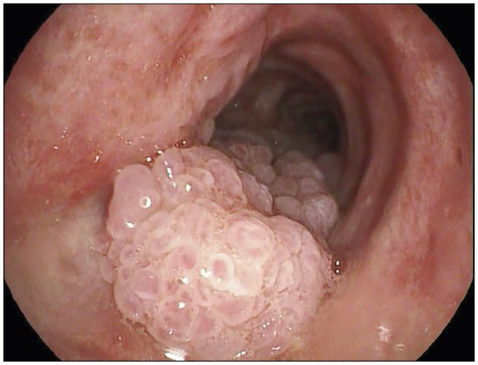 Respiratory Papillomatosis