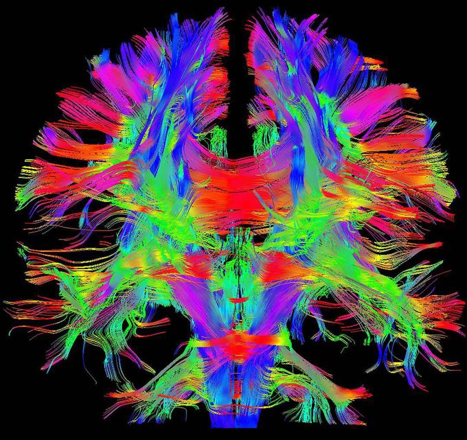 Awesome Human Brain Imaging ➡ New 3-tesla MRI scanner Magnetom Prisma