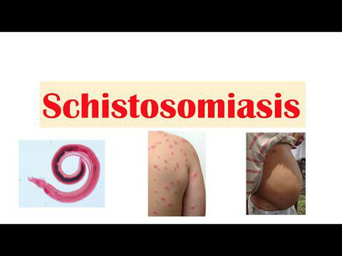 Schistosomiasis of Bladder