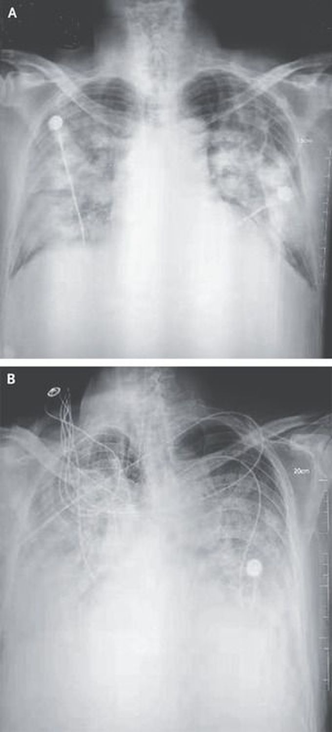 A Novel Coronavirus from Patients with Pneumonia in China, 2019 | NEJM