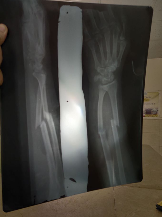 Radius + Ulna fracture