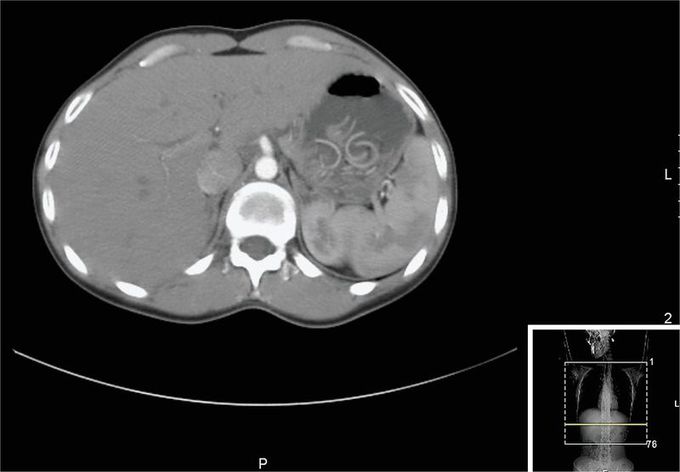 Gastric Ascaris Infection