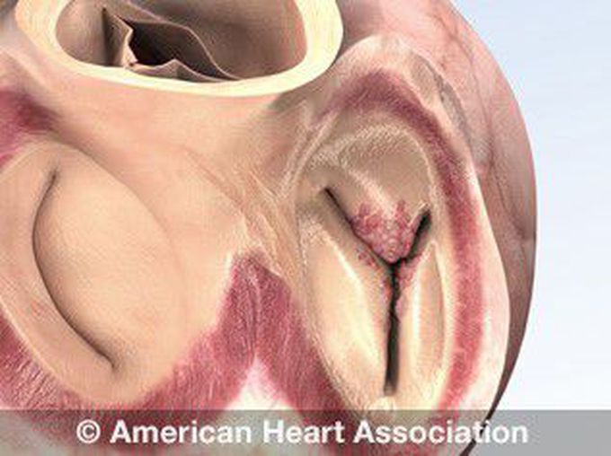 Infective endocarditis