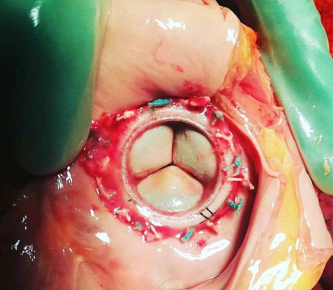 Biological prosthetic mitral valves