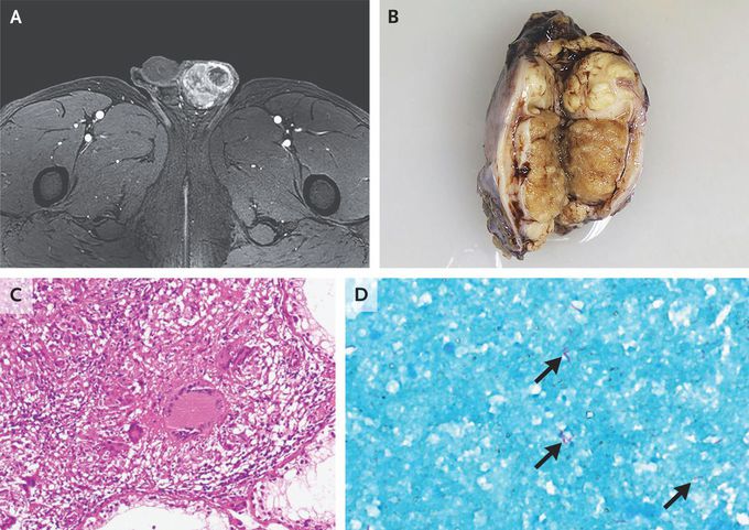 Testicular Tuberculosis