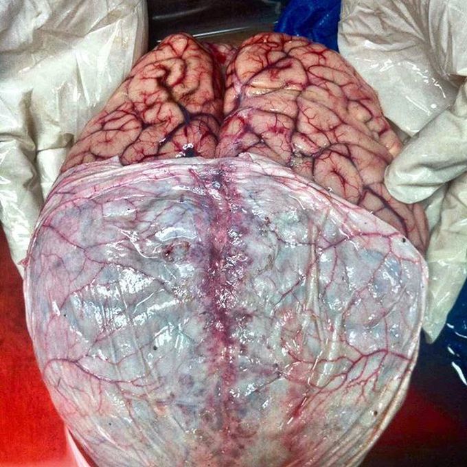 Human Brain, Enclosed in Dura mater