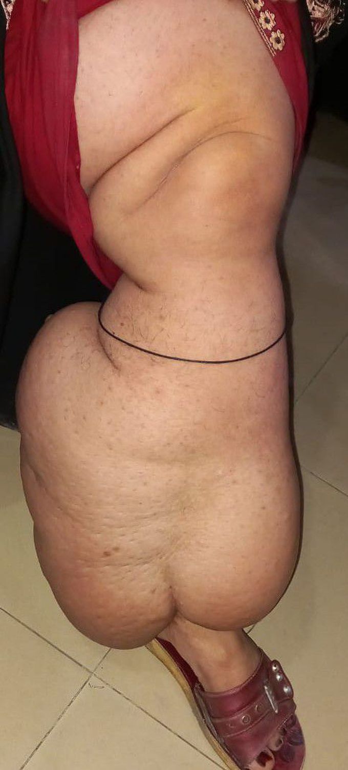 Elephantitis