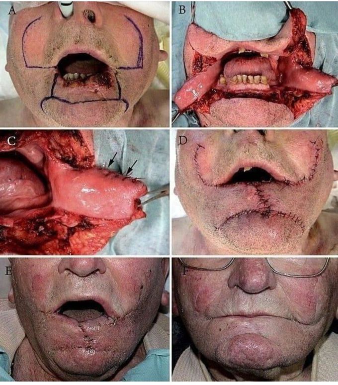 A Brilliant Maxillofacial Surgery