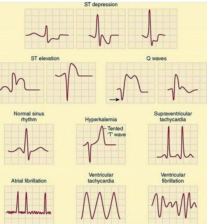 Types of Arrhythmias