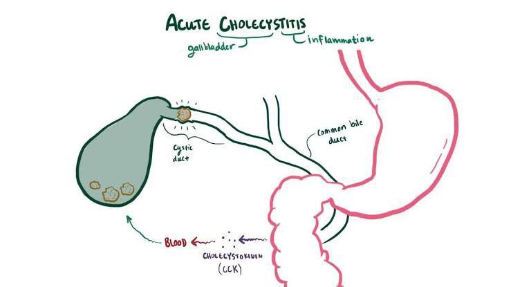 Acute cholecystitis - MEDizzy