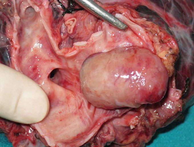 What Are Lung Carcinoid Tumors?