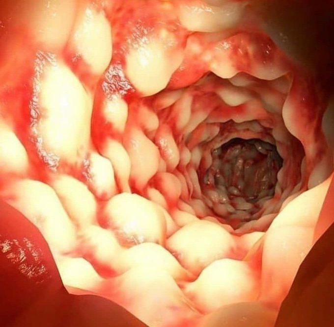 CROHN'S DISEASE