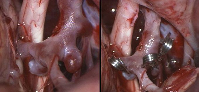 Brain Aneurysms Clipping