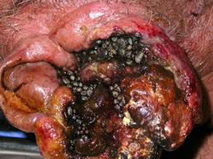 Symptom of myiasis